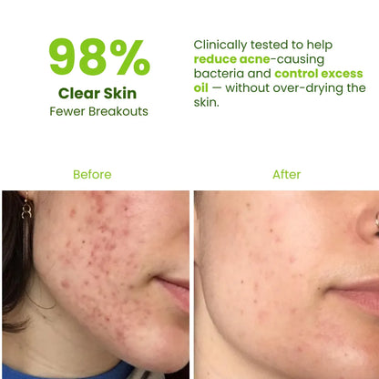 Herbal Neem Essence Face Wash | Remove Acne