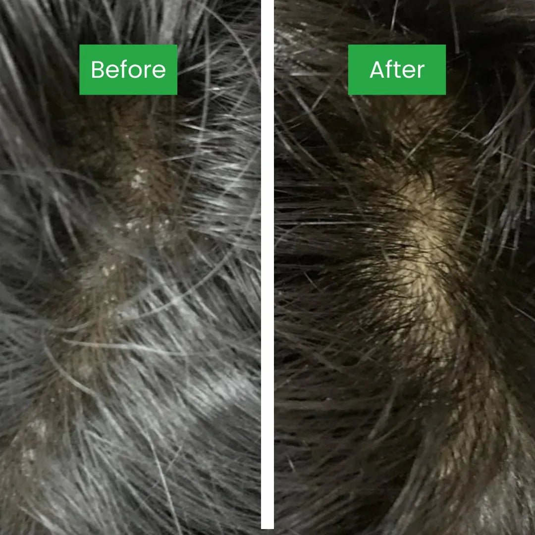 Dandruff Detox (Anti Dandruff) Non-Drying Shampoo Sulfate Free, Paraben free