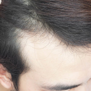 Hair Fall
